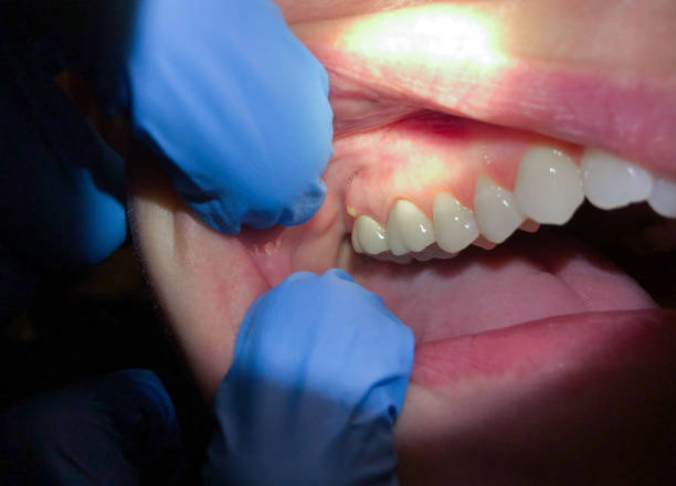 Best Emergency Tooth Extraction in Baileyton, AL