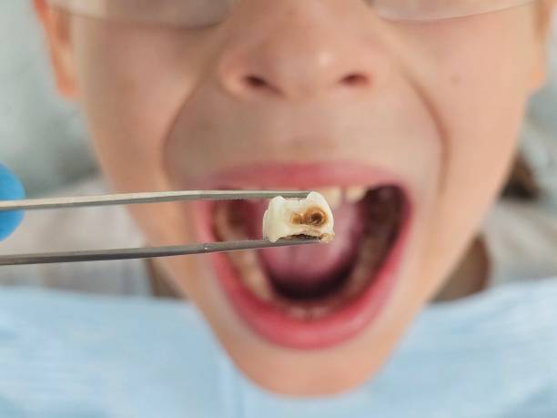 Best Emergency Wisdom Teeth Removal in Baileyton, AL